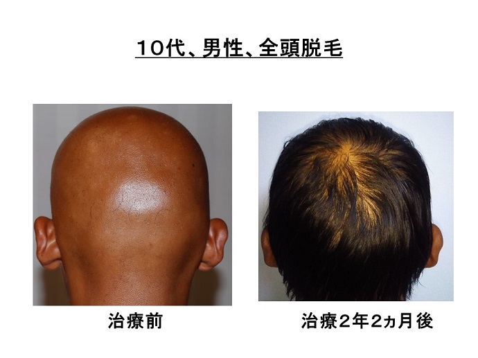 円形脱毛症　病院